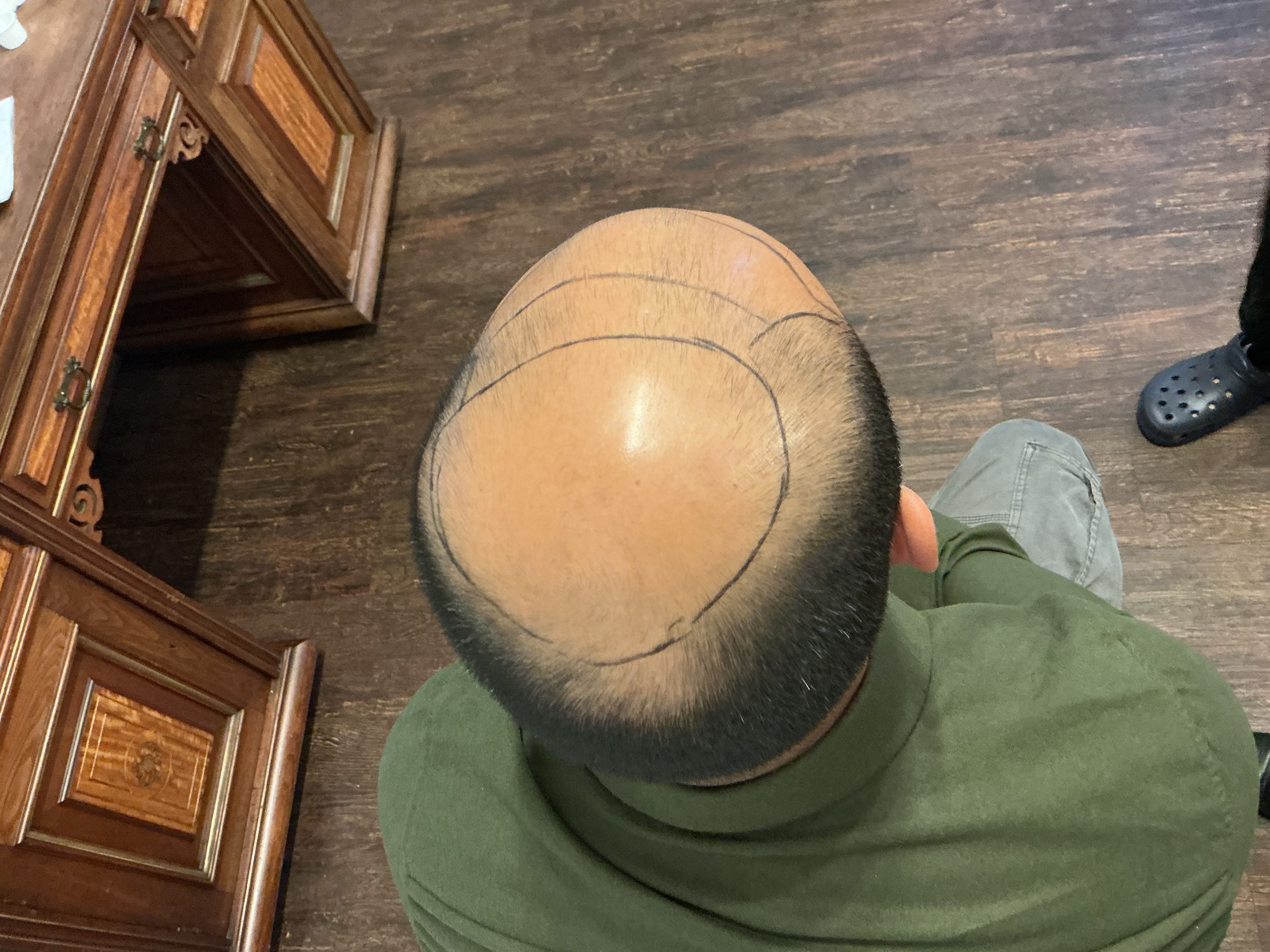 Norwood 7 hair transplant — Hussain result photo 3